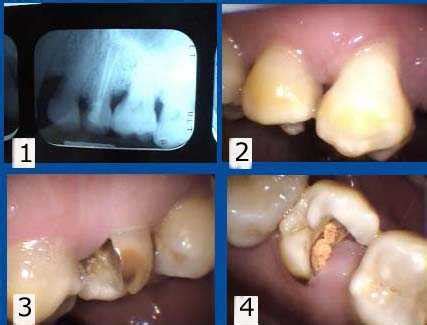 Crown lengthening periodontal gum surgery