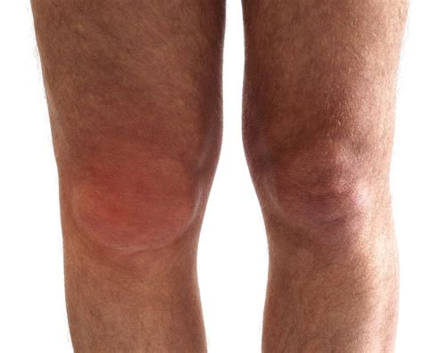 Swollen Knee Treatment | atelier-yuwa.ciao.jp