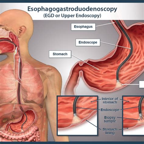 Upper GI Endoscopy - drchetankalal