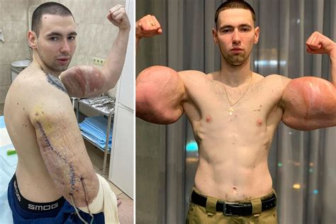 Russian 'Popeye' who injected triceps with OIL has life-saving surgery ...