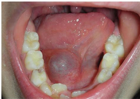 Mucocele – Medicina Orale