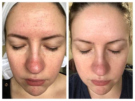 [B&A] Fungal acne after 2 weeks of treatment : r/SkincareAddiction