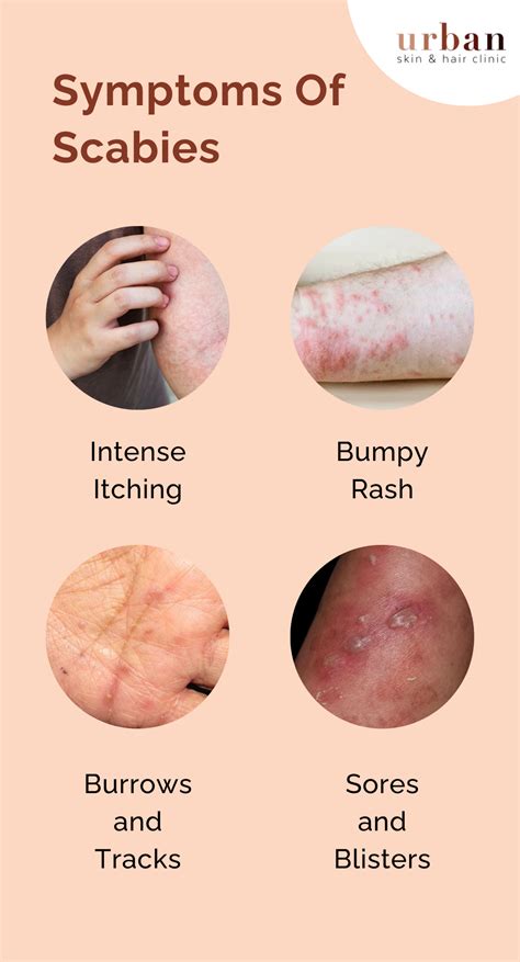 Scabies Types, Causes, Symptoms & Treatment | USHC