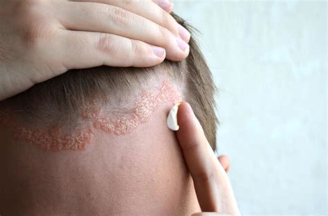 Seborrheic Dermatitis | Ferrara Dermatology