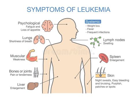 Leukemia Stock Illustrations – 4,793 Leukemia Stock Illustrations ...