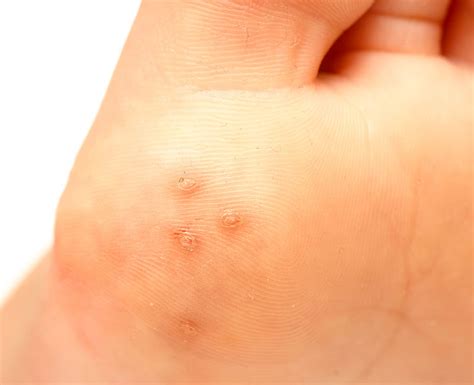 Warts: How To Identify, Causes, Types, Treatment & Prevention