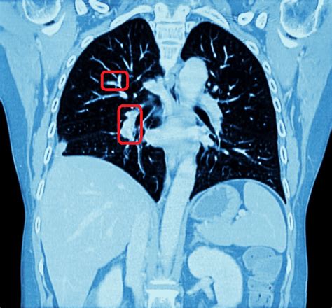 Automated Chest CT Scan Analysis with Deep Learning Classifier