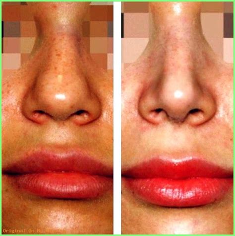 Review Of Nose Job Before And After Female Bulbous 2022 | My Reff