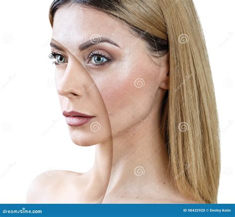 Adult Woman with Acne before and after Treatment. Stock Photo - Image ...