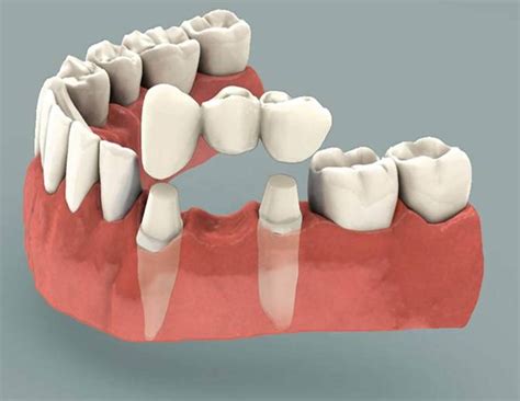 Dental Bridge Abutment