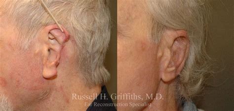 Ear Reconstruction Surgeon - Dr. Russell Griffiths