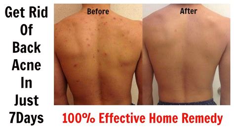 How To Get Rid Of Back Acne And Chest Acne | Programsrun.com