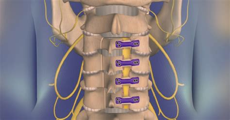 Best Laminoplasty Doctors & Hospitals in India