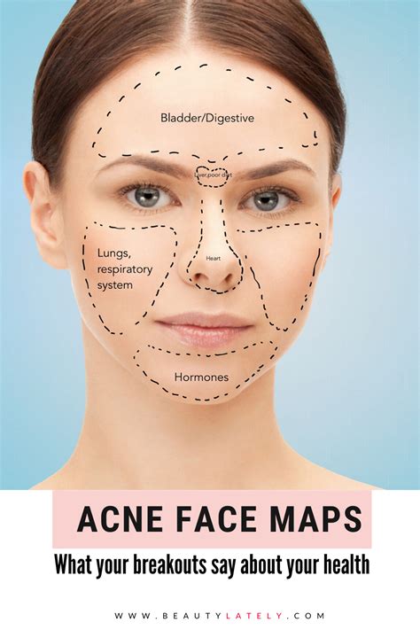 Acne face maps: the reasons behind your breakouts | Face mapping acne ...