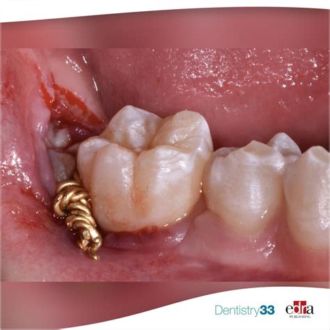 The treatment of impacted mandibular second molars using brass wire: a ...