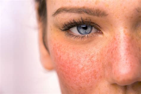 Rosacea Treatment - Melbourne | Victorian Laser & Skin Clinic