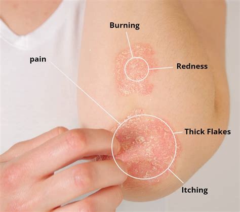 Psoriasis Treatment - The Dermatology Office