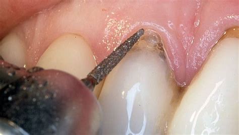 Papilla Reconstruction | Dr. Peter Nordland | Periodontist