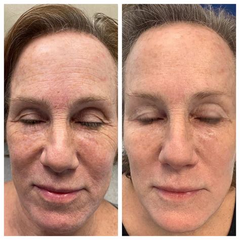 Comprehensive Facial Rejuvenation Before and After - St. Louis ...