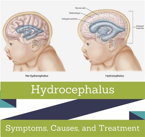 Hydrocephalus : Symptoms, Picture, Causes, And Treatment