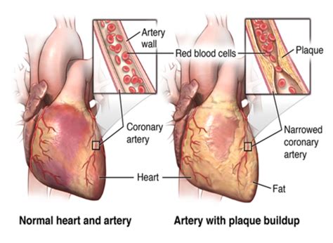 General Surgery - Unit 3 Cardiothoracic surgery Flashcards | Quizlet