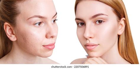 Young Woman Before After Acne Treatment Stock Photo 2207506891 ...