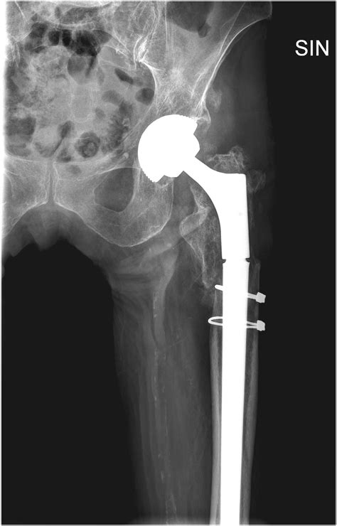 Diagnosis and management of periprosthetic femoral fractures after hip ...