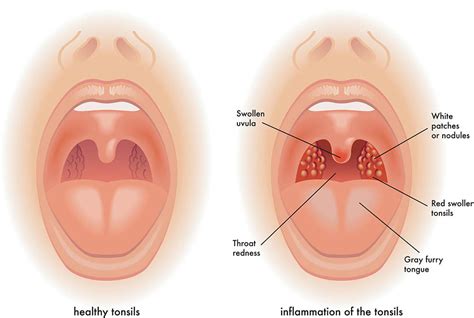 Healthy Tonsils