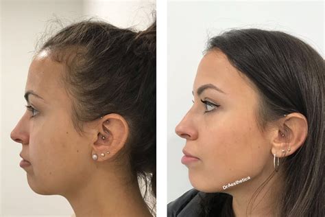 Botox for Jowls: Non Surgical Jowl Lift - Dr Aesthetica in 2023 | Jowl ...