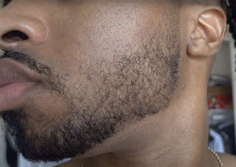 Minoxidil Before And After Beard