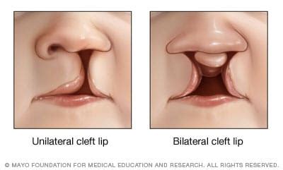 Cleft lip and cleft palate - Symptoms and causes - Mayo Clinic