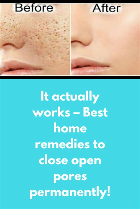 It actually works – Best home remedies to close open pores permanently ...