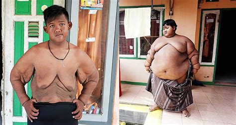 Photo: world’s heaviest child loses an incredible 100kg, now weighs ...