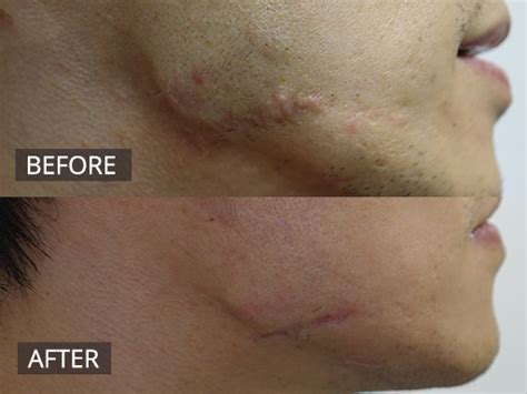 Keloid Scar Removal Treatment | The DOC Clinic Melbourne