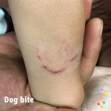 Is A Dog Bite A Tetanus Prone Wound