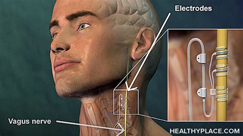 Vagus Nerve Stimulation Side Effects