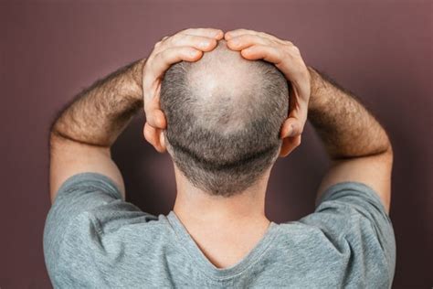 7 common hair loss myths: the truth about male pattern baldness