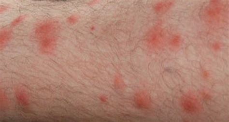 Chigger Bites – Pictures, Symptoms, Causes, Treatment – Inside the Clinic