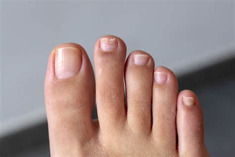 Home Remedies To Treat Toenail Fungus - Health Advice Web