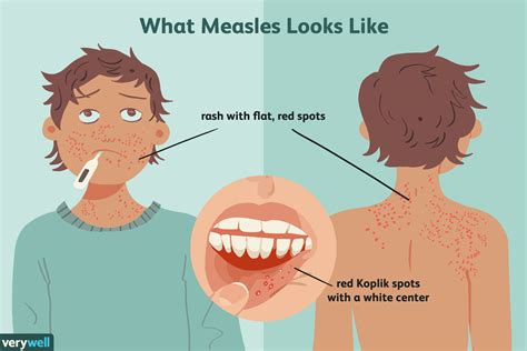 Measles: Overview and More