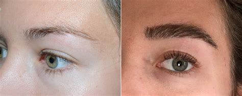 Eyebrow Transplantation Photos | Miami, FL | Patient 18116