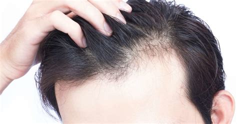 Vitamin D deficiency hair loss: Symptoms and treatment