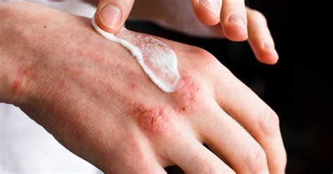 Eczema Treatments Dermatologists Use on Themselves | The Healthy