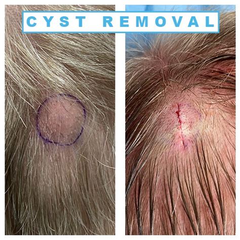 How To Get Rid Of A Cyst On The Face - Askexcitement5