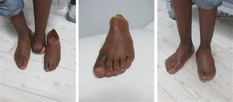 Partial Foot Silicone Prosthesis at Rs 65000 | Artificial Silicone Foot ...