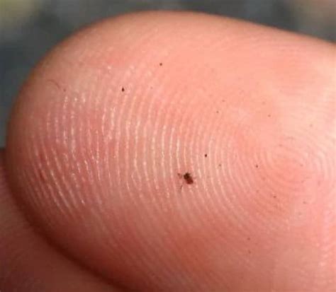 How to Get Rid of Chiggers on Skin: First Aid After Chigger Bite - 2