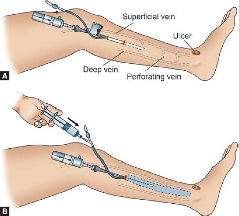 Figure 4 from Subfascial Endoscopic Perforator Surgery in Perforator ...