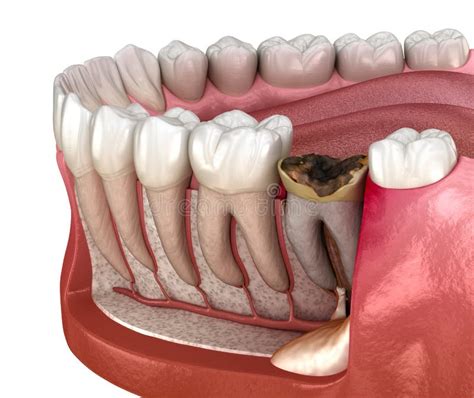 Periostitis Tooth - Lump on Gum Above Tooth. Medically Accurate Dental ...