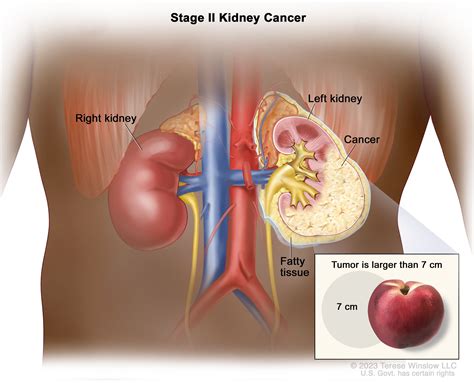 How To Diagnose Kidney Cancer - Soupcrazy1