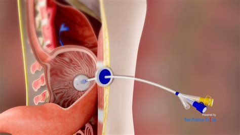 Gastrostomy Tube Placement Video | Medical Video Library